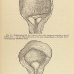 1881 Medical Book Lot Medicine Diseases Surgery Charcot Diet Health Anatomy