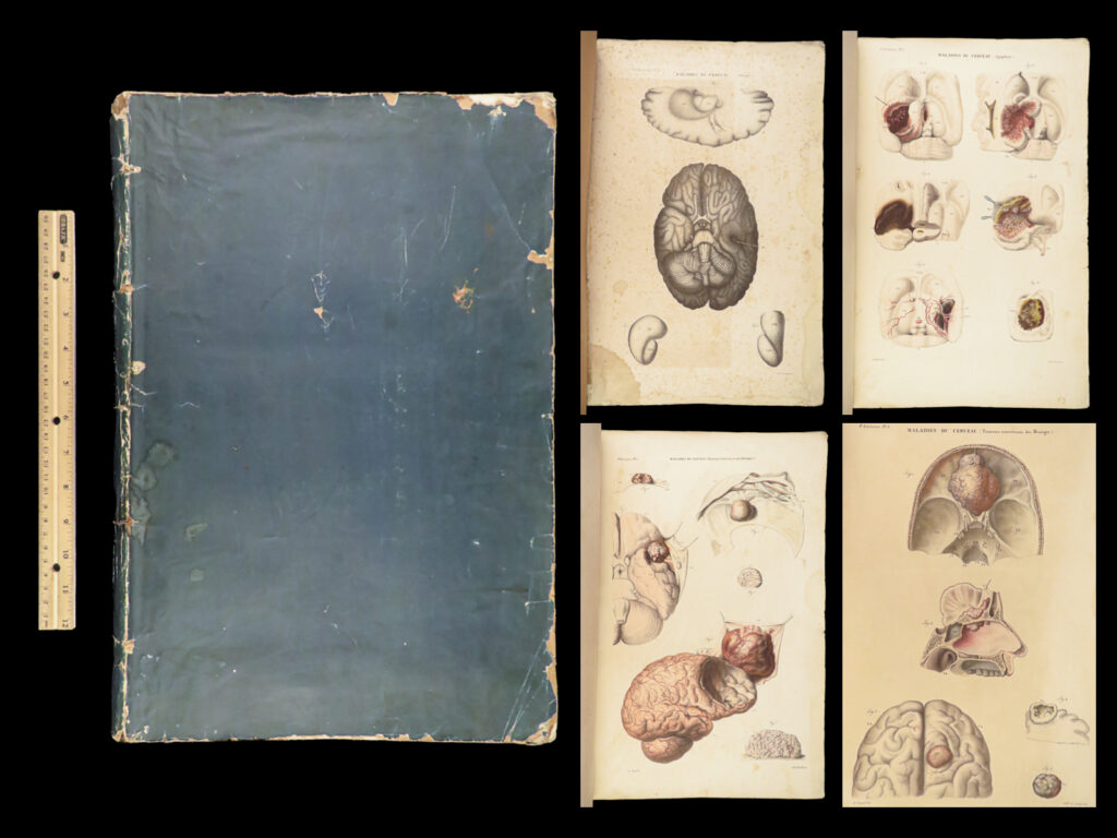 1829 anatomy & pathology atlas 86 color illustrated disease cruveilhier medicine | jean cruveilhier was a 19<sup>th</sup>-century french anatomist who is primarily remembered for his book “<em>anatomie patholigique</em>”. This book was considered one of the best of its kind in the first half of the 19<sup>th</sup>-century, much in part to him being the first to describe multiple sclerosis.   this impressive folio atlas tome from cruveilhier’s “<em>anatomie</em>” contains upwards of 100 hand-colored engravings depicting diseased human organs and anatomy.  