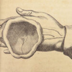 1682 SURGERY 1st ed Observations of Janszoon Meekeren | Dutch Medicine Plates