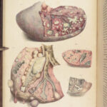 1838 Pathological Anatomy – Robert Carswell | Color Illustrated Surgery Medicine