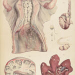 1838 Pathological Anatomy – Robert Carswell | Color Illustrated Surgery Medicine