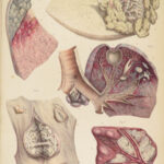1838 Pathological Anatomy – Robert Carswell | Color Illustrated Surgery Medicine