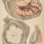 1838 Pathological Anatomy – Robert Carswell | Color Illustrated Surgery Medicine