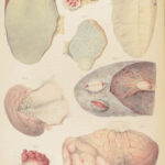 1838 Pathological Anatomy – Robert Carswell | Color Illustrated Surgery Medicine