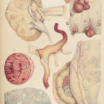 1838 Pathological Anatomy – Robert Carswell | Color Illustrated Surgery Medicine