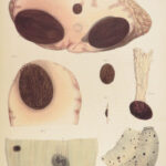 1838 Pathological Anatomy – Robert Carswell | Color Illustrated Surgery Medicine