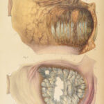 1838 Pathological Anatomy – Robert Carswell | Color Illustrated Surgery Medicine