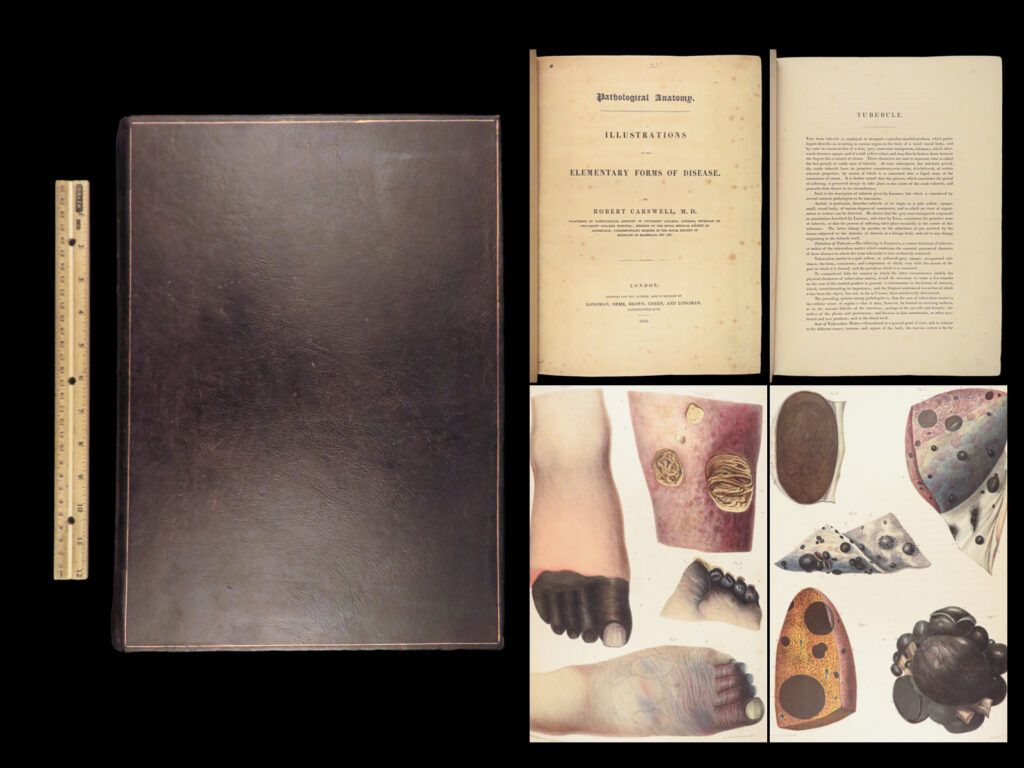 1838 pathological anatomy – robert carswell | color illustrated surgery medicine | robert carswell was a 19<sup>th</sup>-century scottish pathologist who is primarily remembered for his contributions to the study of multiple sclerosis. Today, however, his fame rests on the impressive, color illustrations of diseased human anatomy. In his book “<em>illustrations of the elementary forms of disease</em>”, carswell describes the changes in diseased tissues, skin diseases, localized diseases in organs, and full-system pathology.   this collection of 28 plates from carswell’s “<em>illustrations</em>” are some of the most desirable medical plates from the 19<sup>th</sup>-century. In fact, it is rare to find so many of these plates together as they are often extracted and displayed as individual pieces.   item number: #26987 price: $1950  