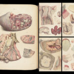 1838 Pathological Anatomy – Robert Carswell | Color Illustrated Surgery Medicine