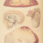 1838 Pathological Anatomy – Robert Carswell | Color Illustrated Surgery Medicine