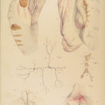 1838 Pathological Anatomy – Robert Carswell | Color Illustrated Surgery Medicine