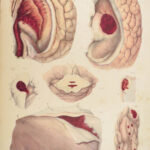 1838 Pathological Anatomy – Robert Carswell | Color Illustrated Surgery Medicine