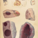 1838 Pathological Anatomy – Robert Carswell | Color Illustrated Surgery Medicine