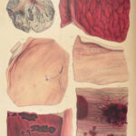 1838 Pathological Anatomy – Robert Carswell | Color Illustrated Surgery Medicine