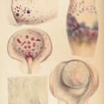 1838 Pathological Anatomy – Robert Carswell | Color Illustrated Surgery Medicine