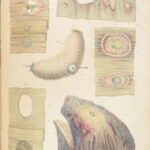 1838 Pathological Anatomy – Robert Carswell | Color Illustrated Surgery Medicine
