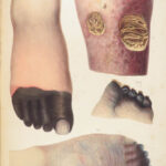 1838 Pathological Anatomy – Robert Carswell | Color Illustrated Surgery Medicine
