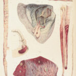 1838 Pathological Anatomy – Robert Carswell | Color Illustrated Surgery Medicine