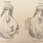 A System of Surgery – Samuel D. Gross – 1872 | 1400+ Anatomy Engravings