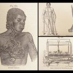 A System of Surgery – Samuel D. Gross – 1872 | 1400+ Anatomy Engravings