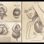 A System of Surgery – Samuel D. Gross – 1872 | 1400+ Anatomy Engravings