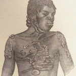 A System of Surgery – Samuel D. Gross – 1872 | 1400+ Anatomy Engravings