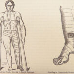 A System of Surgery – Samuel D. Gross – 1872 | 1400+ Anatomy Engravings