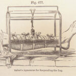 A System of Surgery – Samuel D. Gross – 1872 | 1400+ Anatomy Engravings