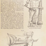 A System of Surgery – Samuel D. Gross – 1872 | 1400+ Anatomy Engravings