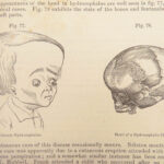 A System of Surgery – Samuel D. Gross – 1872 | 1400+ Anatomy Engravings
