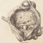 A System of Surgery – Samuel D. Gross – 1872 | 1400+ Anatomy Engravings