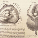 A System of Surgery – Samuel D. Gross – 1872 | 1400+ Anatomy Engravings