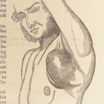A System of Surgery – Samuel D. Gross – 1872 | 1400+ Anatomy Engravings