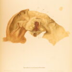 1852 Rokitansky Diseases of ARTERIES Medicine Surgery Illustrated German FOLIO