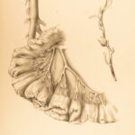 1852 Rokitansky Diseases of ARTERIES Medicine Surgery Illustrated German FOLIO