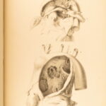 1852 Rokitansky Diseases of ARTERIES Medicine Surgery Illustrated German FOLIO