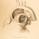 1852 Rokitansky Diseases of ARTERIES Medicine Surgery Illustrated German FOLIO