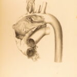 1852 Rokitansky Diseases of ARTERIES Medicine Surgery Illustrated German FOLIO