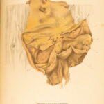 1852 Rokitansky Diseases of ARTERIES Medicine Surgery Illustrated German FOLIO