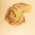 1852 Rokitansky Diseases of ARTERIES Medicine Surgery Illustrated German FOLIO