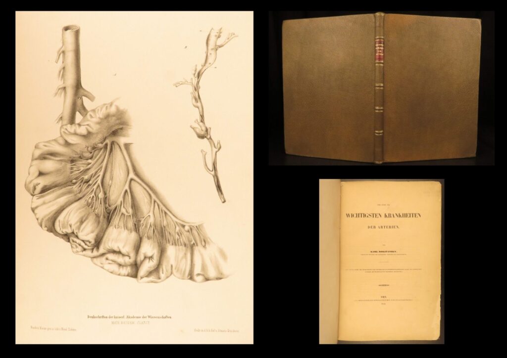 1852 rokitansky diseases of arteries medicine surgery illustrated german folio |   carl von rokitansky was a 19<sup>th</sup>-century austrian physician who, in addition to establishing schools of medicine, was a key figure in developing diagnostic methods using science. It was through his own methods of testing and experimenting that he was able to identify some of the most common diseases of the arteries. In his book “diseases of the arteries”, rokitansky describes his autopsy methods for looking at and describing arteries. First published in 1851, this book was a massive success and proved to be a reliable resource for physicians treating arterial diseases. This 1852 folio of rokitansky’s ‘arteries’ includes 23 full-page engravings. While 19<sup>th</sup>-century medical folios are rare in themselves, a work specifically focused on arteries is considerably more exclusive.   item number: #26163 price: $750