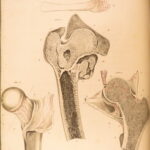 1823 Astley Cooper Medicine & Surgery Orthopedic Joint Dislocations Fractures
