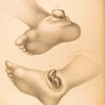1823 Astley Cooper Medicine & Surgery Orthopedic Joint Dislocations Fractures