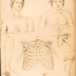 1823 Astley Cooper Medicine & Surgery Orthopedic Joint Dislocations Fractures