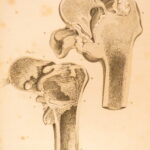 1823 Astley Cooper Medicine & Surgery Orthopedic Joint Dislocations Fractures