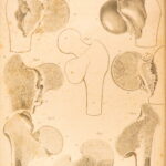1823 Astley Cooper Medicine & Surgery Orthopedic Joint Dislocations Fractures